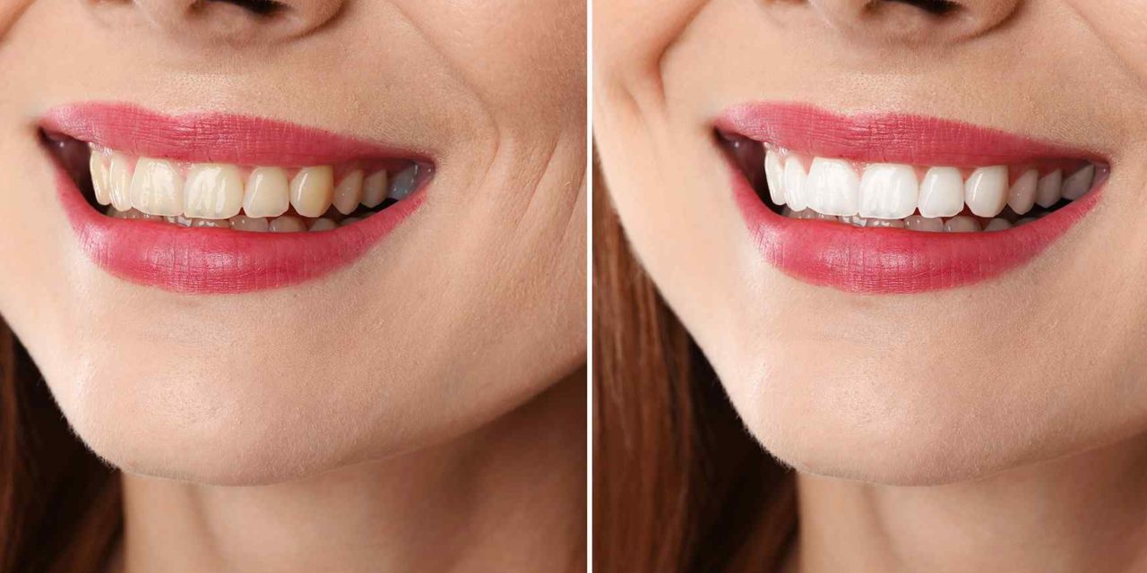 Eleven tips to treat white spots on teeth