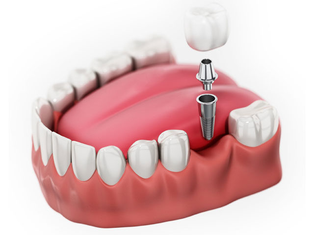 https://thewoodlandsdental.co.uk/wp-content/uploads/2021/07/Dental1-640x480.jpg