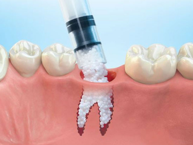 https://thewoodlandsdental.co.uk/wp-content/uploads/2021/08/Graft1-640x480.jpg