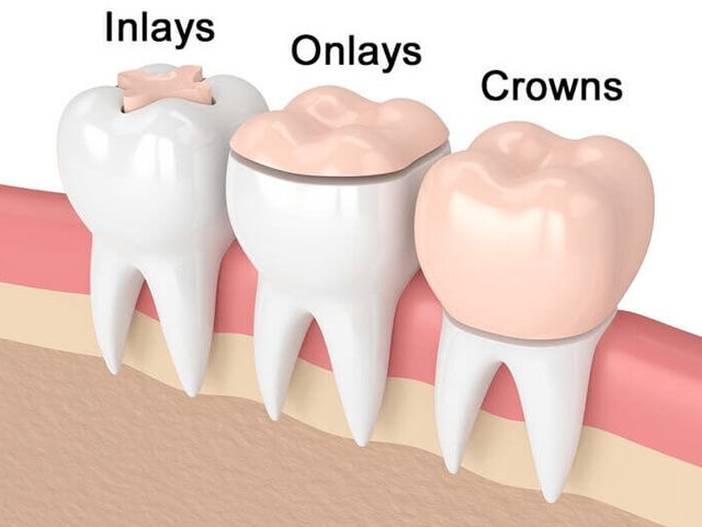 https://thewoodlandsdental.co.uk/wp-content/uploads/2021/08/crown2-640x480.jpg