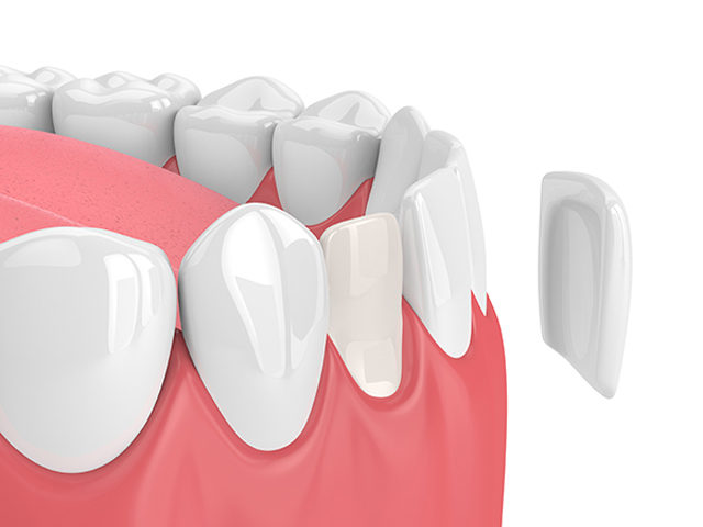 https://thewoodlandsdental.co.uk/wp-content/uploads/2021/08/porcelain2-640x480.jpg