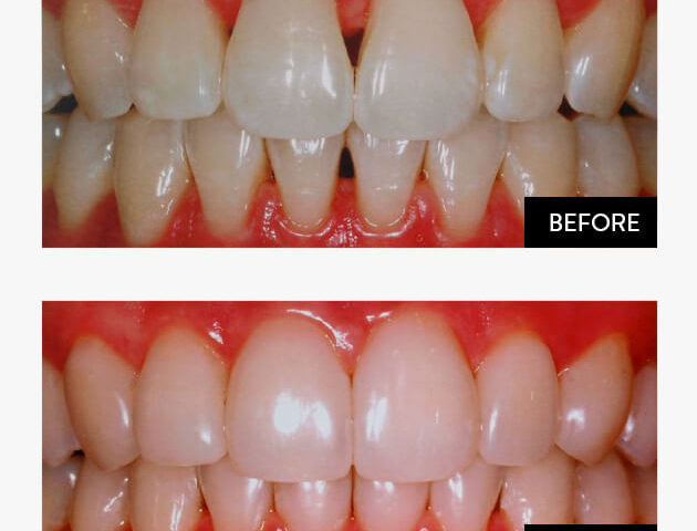 composite2 https://thewoodlandsdental.co.uk/wp-content/uploads/2021/12/composite2-630x480.jpg