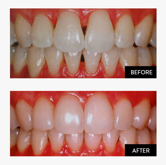 Composite Bonding Woodlands Dental
